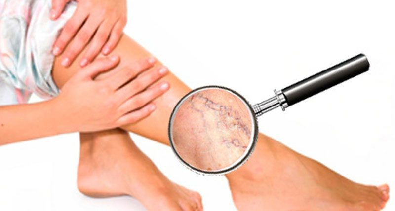 Kas yra kojų venų varikozė